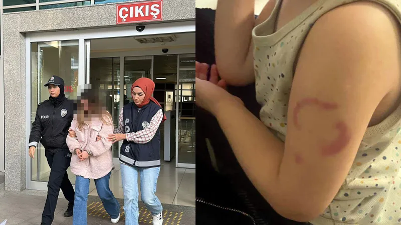 Kreşte Şok! Öğretmen 3 Yaşındaki Çocuğun Kolunu Isırdı!